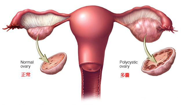 多囊卵巢影响做试管？喜孕多告诉你该怎样治疗多囊卵巢综合征
