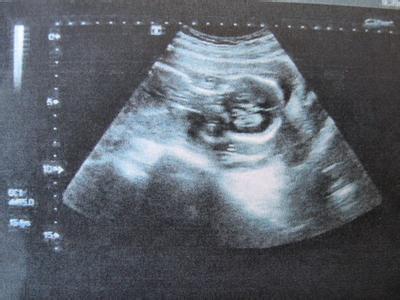 B超对胎儿有影响吗？怀孕多少周可以做B超比较合适？