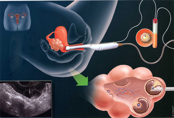 输卵管检查有什么意义？做试管婴儿，需要查输卵管吗？