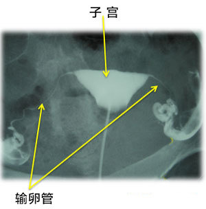 试管婴儿适应症之输卵输卵管梗阻_输卵管堵塞能做试管吗？