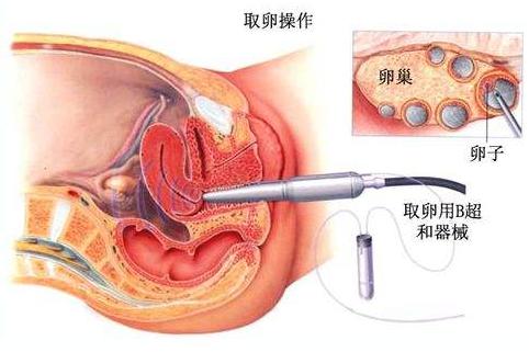 海外三代试管婴儿取卵后  妈妈该如何保养身体