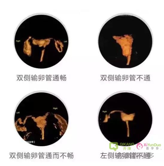 输卵管堵塞也是分级别的，堵塞时选择疏通自然怀孕还是做试管婴儿呢？