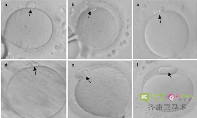影响试管婴儿成功率的卵子异常形态之第一极体异常