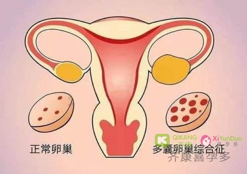 肥胖的多囊女性有哪些危害？多囊患者怎样科学的控制体重？