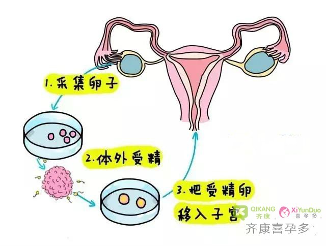 喜孕多海外试管：试管婴儿胚胎移植有哪几种方式移植？