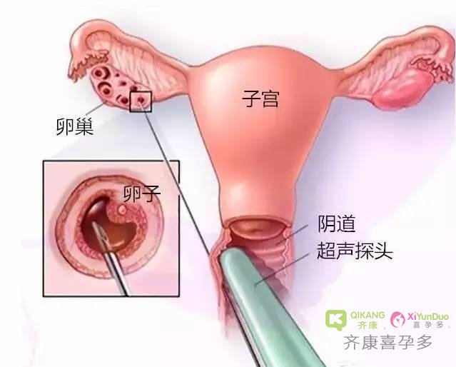 齐康喜孕多对试管婴儿各流程的详细科普介绍