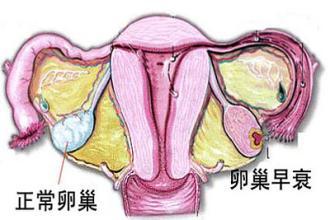 哪类女性容易卵巢早衰？卵巢早衰如何调理？