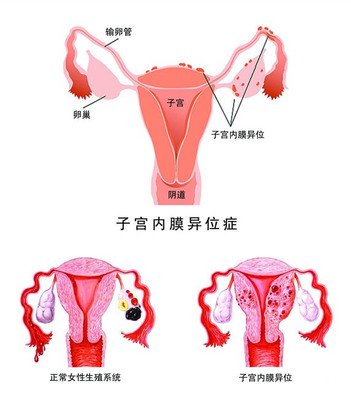 女性经常性的腰疼，究竟是什么原因引起的？小心妇科病