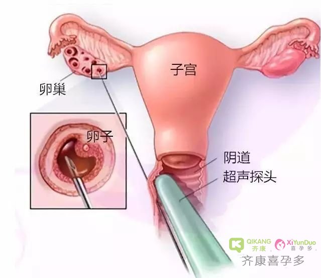 做试管取卵是重要环节，为提高成功率应如何规避取卵数少？