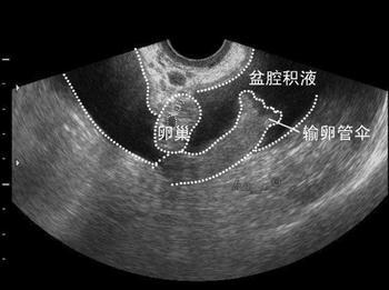 什么是生理性盆腔积液?什么是病理性盆腔积液?齐康喜孕多告诉你