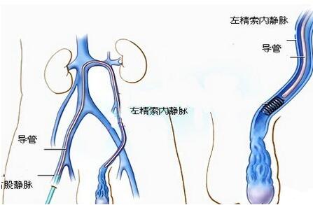 影响男性不育的魔咒无精症该如何应对？无精症能做试管婴儿吗？