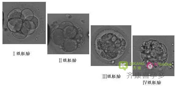 一分钟了解试管婴儿胚胎等级 齐康喜孕多一站式海外辅助生殖