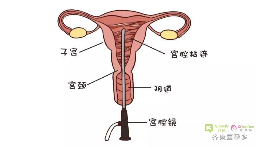 宫腔黏连为什么会导致不孕？宫腔黏连必须要做试管和代Y吗？