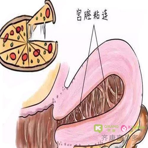 宫腔黏连为什么会导致不孕？宫腔黏连必须要做试管和代Y吗？