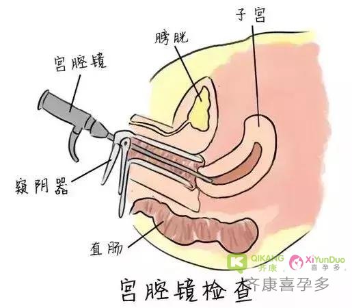 什么是宫腔镜，什么情况下需要做宫腔镜检查