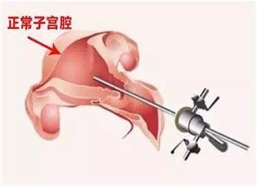 什么是宫腔镜，什么情况下需要做宫腔镜检查