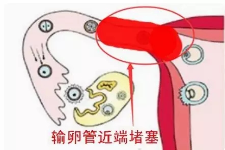 喜孕多海外试管：不孕不育可能是这九大疾病导致，要格外注意了