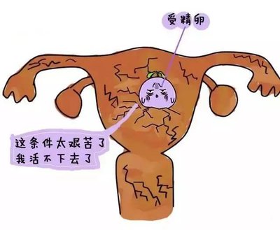 自然妊娠流产的各种情况和试管婴儿着床不成功的因素