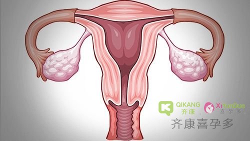 齐康喜孕多温馨提醒：小腹疼痛小心是盆腔炎