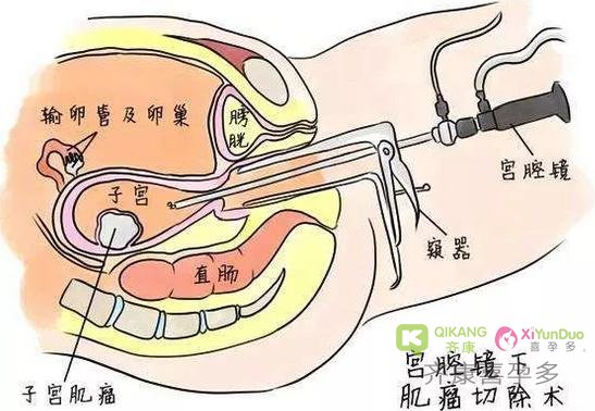 宫腔镜检查到底有什么作用？移植前做宫腔镜有必要吗？