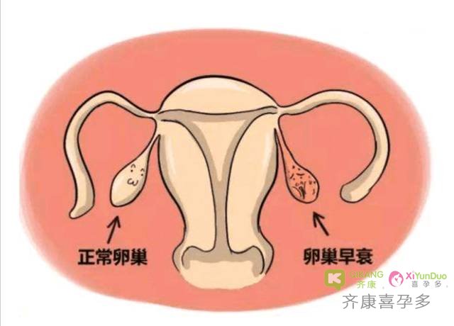 卵巢功能衰竭一般在什么情况下发生？卵巢功能衰竭的症状有哪些？