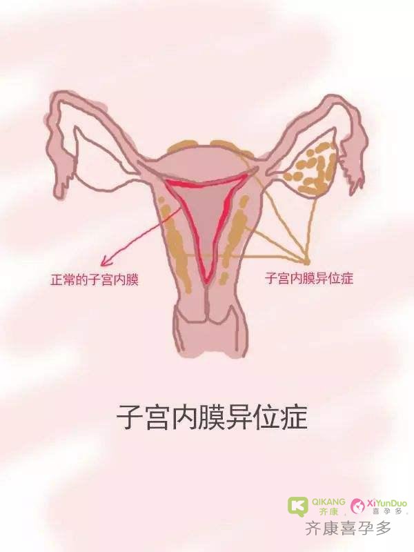 齐康喜孕多告诉你子宫内膜异位症的女性是否可以做试管婴儿