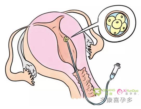 试管婴儿胚胎移植前要怎么憋尿才有助于胚胎着床呢？