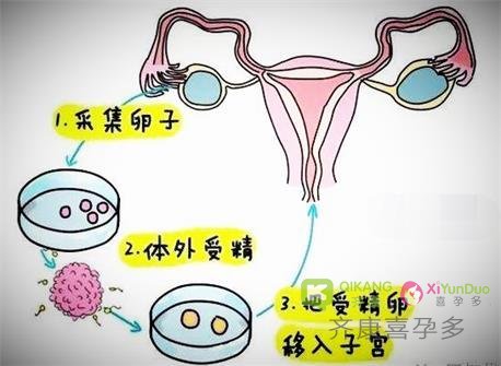 第一、第二、第三代试管应该如何选择呢？