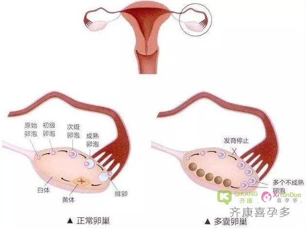 我这么瘦，为什么我也有多囊卵巢综合征？