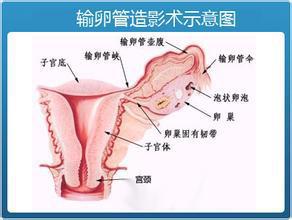 输卵管不通引起的不孕是应该先做腹腔镜手术呢还是直接选择试管婴儿