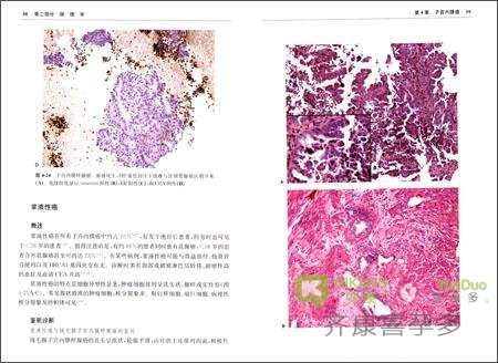 子宫内膜结核还能怀孕吗?能不能去做海外试管婴儿?