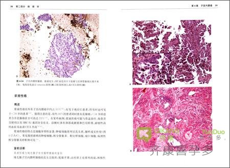 子宫内膜结核还能怀孕吗？能不能去做海外试管婴儿？