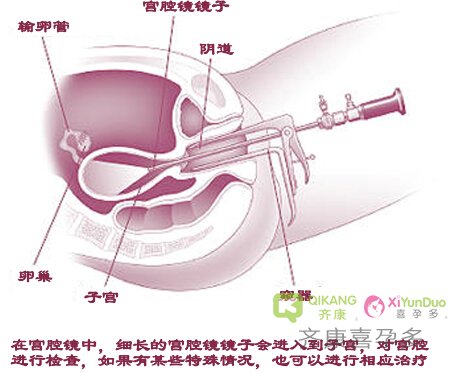 输卵管通而不畅该做手术还是选择试管婴儿辅助生殖?