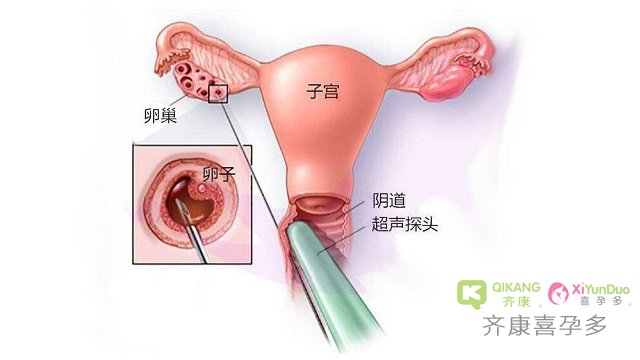 做试管婴儿，取完卵子之后多久来例假正常？