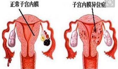 子宫内膜异位症合并卵巢储备低，需要降调吗？