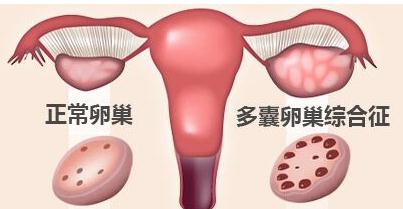 达英35在试管婴儿疗程中的应用:治疗多囊导致内膜薄怎么办？