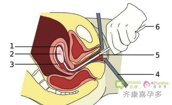 反复胚胎种植失败怎么破？IVF周期治疗性子宫内膜搔刮有帮助