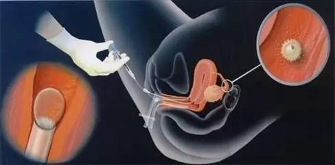 试管移植后到验孕的这段时间，胚胎在子宫内都在做什么？