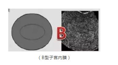 试管移植前阴超报告上的子宫类型ABC是什么意思，如何分类的