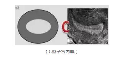 试管移植前阴超报告上的子宫类型ABC是什么意思，如何分类的