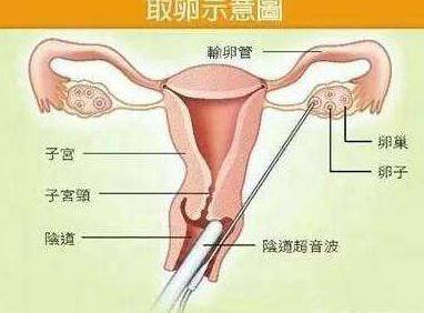 试管婴儿手术对女性身体和心理的影响