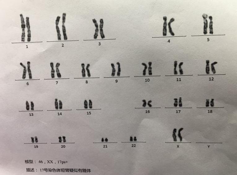 流产的遗传学病因分析