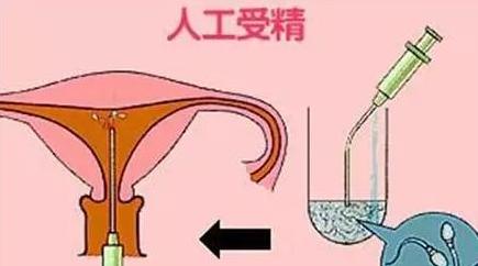 关于人工授精 你想知道的都在这里