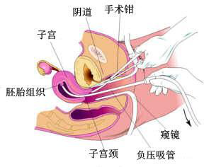 喜孕多告诉你：“3分钟无痛人流”的背后，让人太震惊！