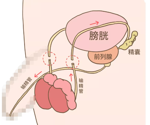 结扎后的精子去哪了？