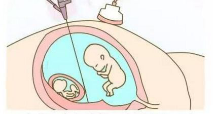 齐康喜孕多告诉你：做试管婴儿，一次移植几个比较合适