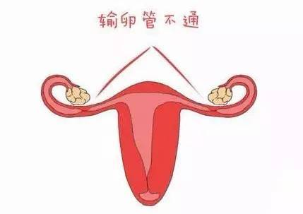 久备不孕？很多女性不孕竟是因为它