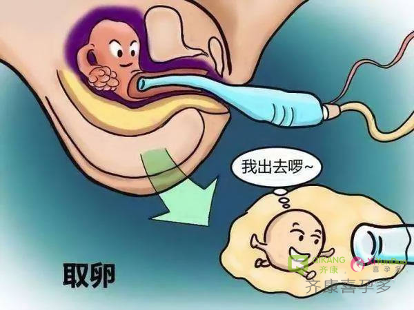 齐康喜孕多告诉你：试管手术疼痛指数