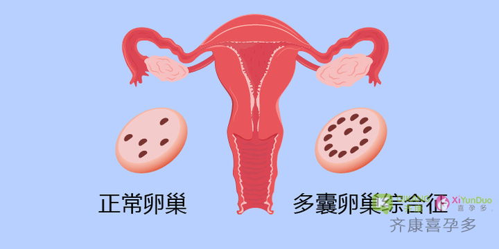 喜孕多告诉你：什么是囊卵巢综合征，如何自我管理