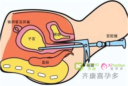 宫腔镜检查是诊断宫腔内病变的金标准！